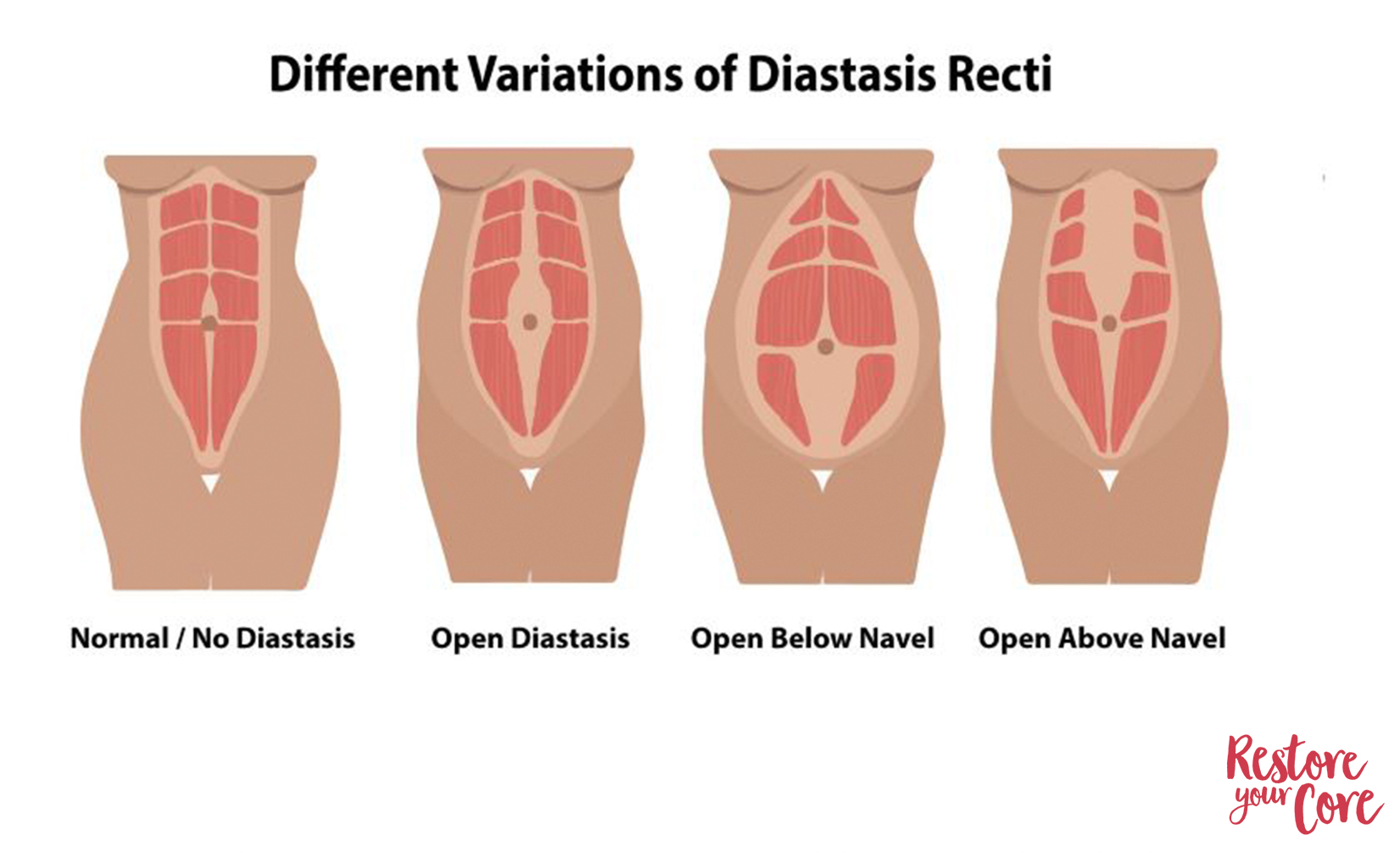 diastasis recti range